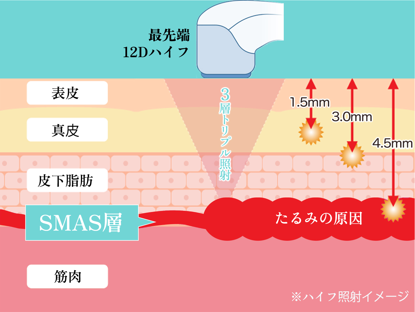 最先端12Dハイフによる３層トリプル照射！ハイフ照射イメージ